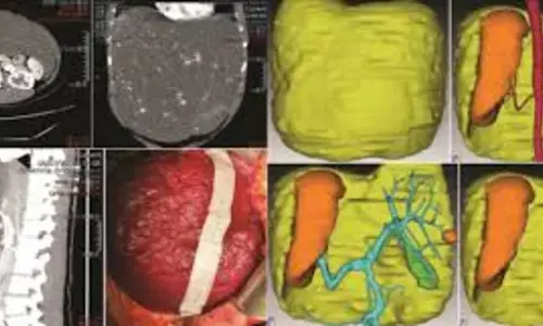 Laparoscopic Resection Feasibile and safe for Giant Hepatic Hemangiomas: Study