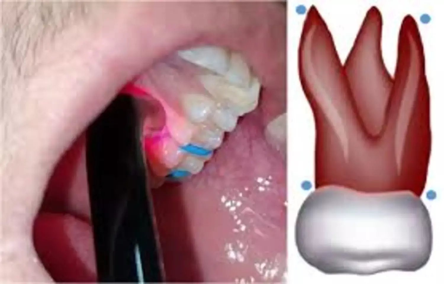 Insufficient Evidence for Routine Use of LIPUS in Orthodontics: Study Insufficient Evidence for Routine Use of LIPUS in Orthodontics: Study