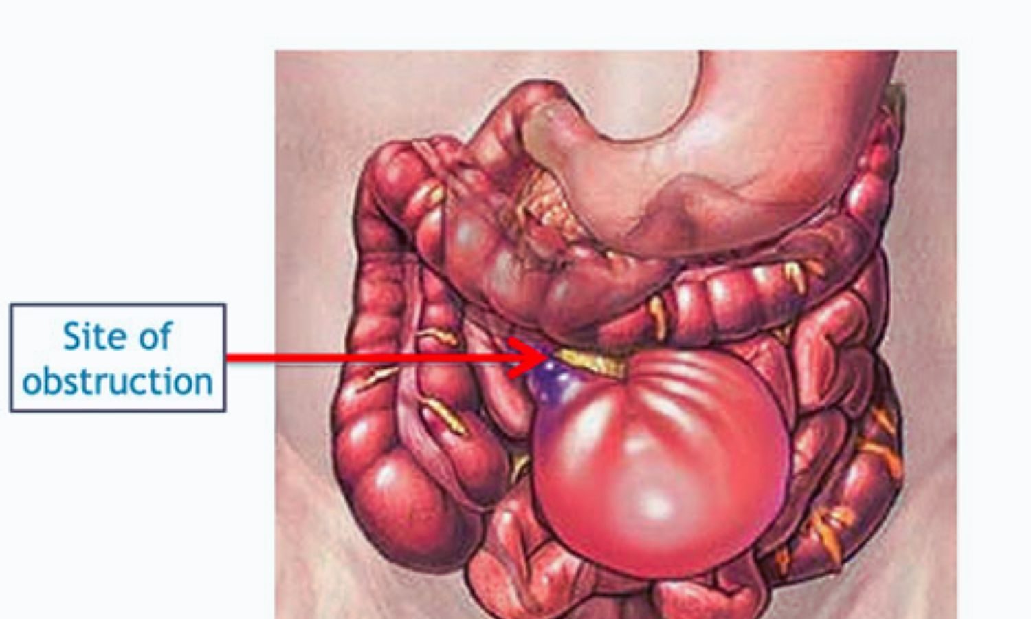 Laparoscopy Offers No Long-Term Edge Over Open Surgery in Small Bowel Obstruction: LASSO Trial