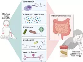 No Overall Association Between Atopic Dermatitis and Contact Sensitization,suggests study No Overall Association Between Atopic Dermatitis and Contact Sensitization,suggests study