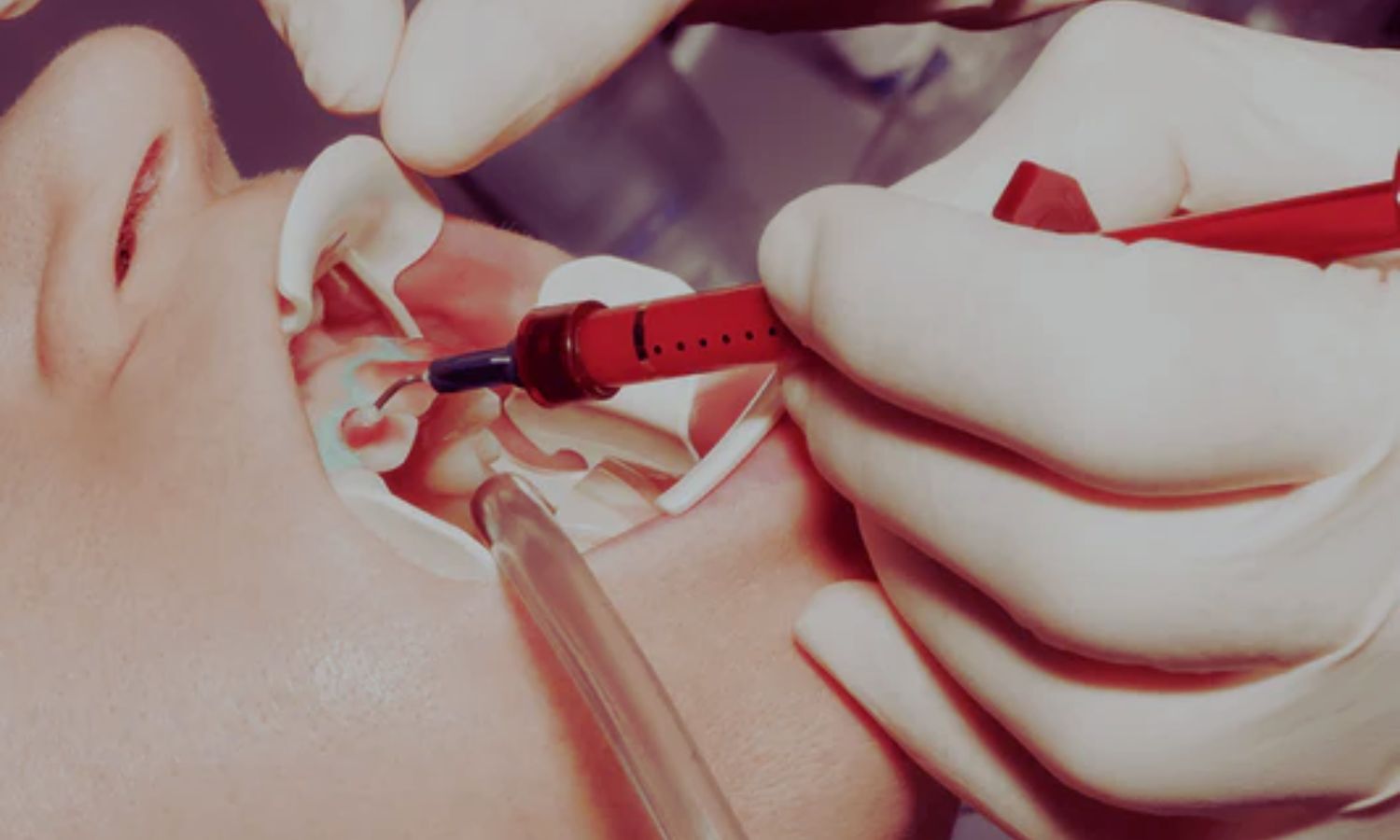 Severe Airway Injury Due to Dental Use of High-Concentration Hydrogen Peroxide: Case Study