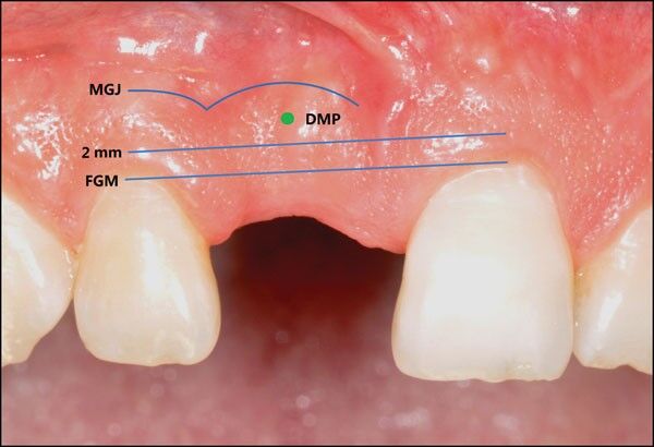 Study details technique to Preserve Peri-Implant Papilla After Reconstructive Surgery