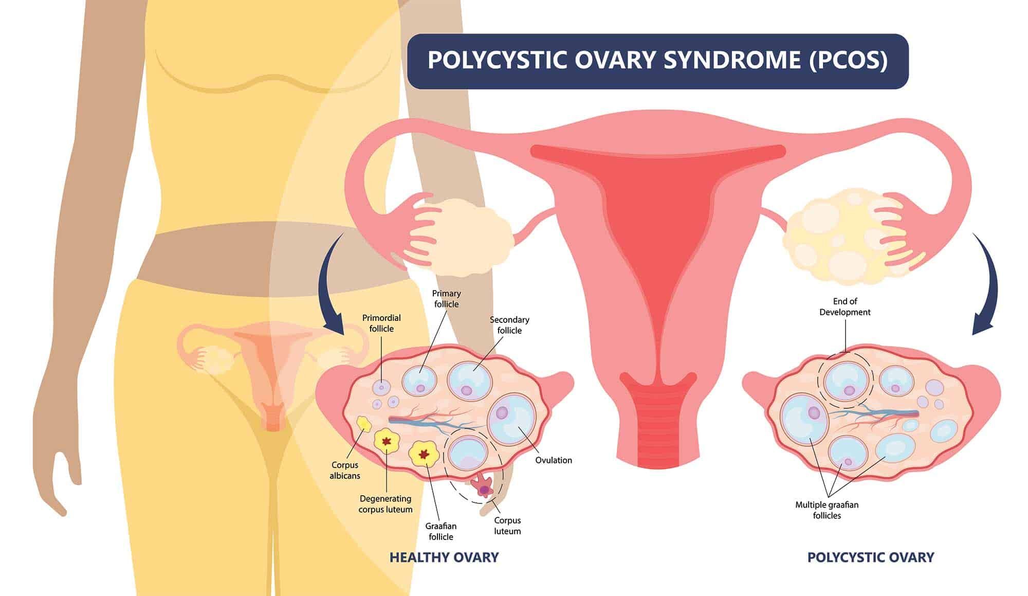 Vitamin D Deficiency Linked to Polycystic Ovary Syndrome and Metabolic Dysfunction: Study