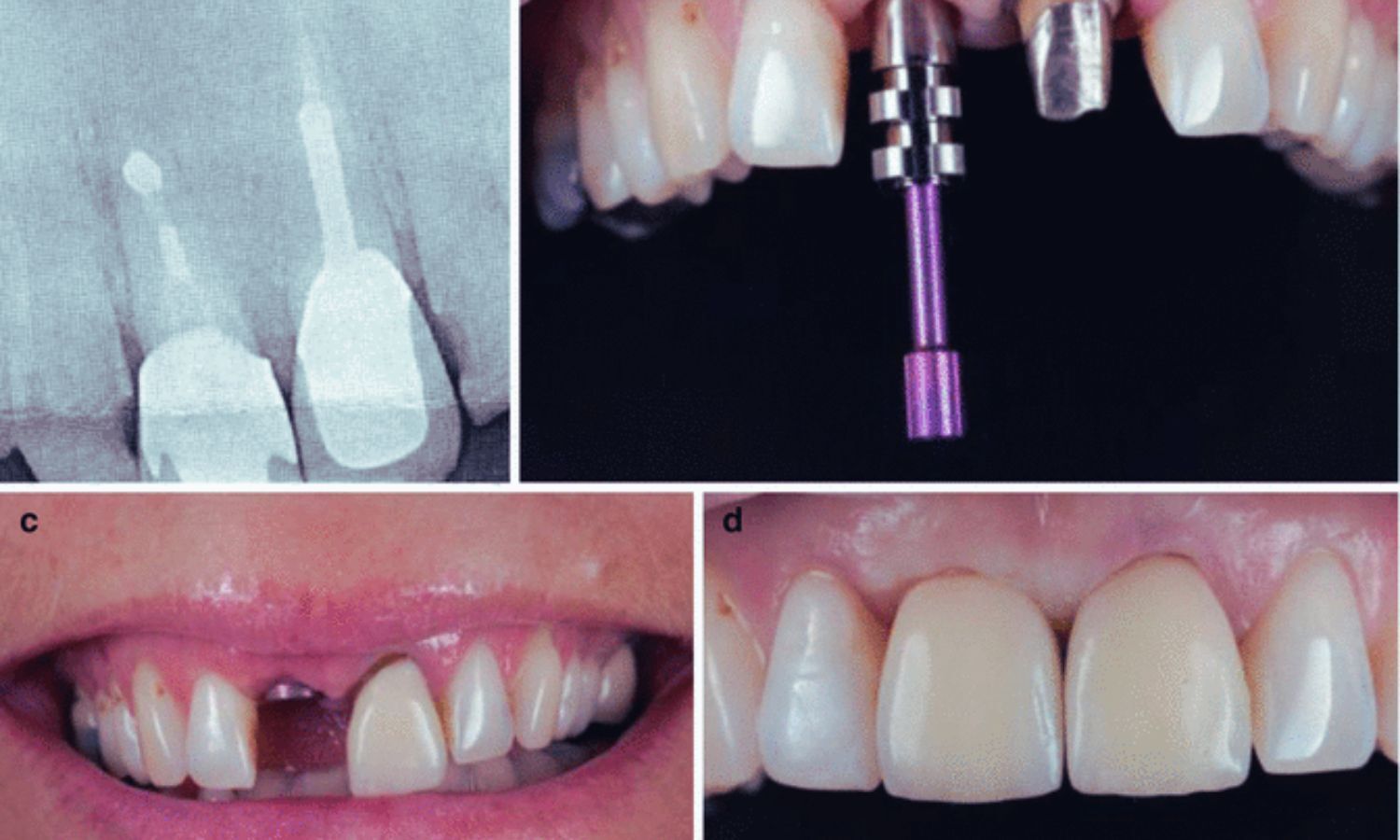 Fiber Posts Associated With Better Survival and Fewer Catastrophic Root Fractures: Study