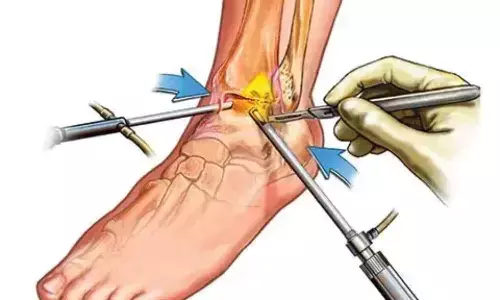 Both Open and Arthroscopic ATFL repair have similar overall complication rates: study