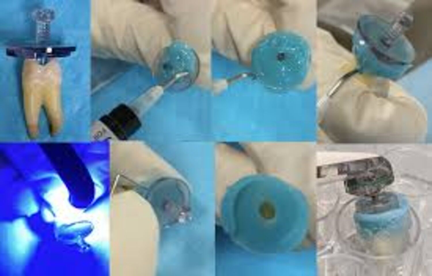 GentleWave technology Shows Promising Antibacterial Efficacy in Root Canal Therapy: Study