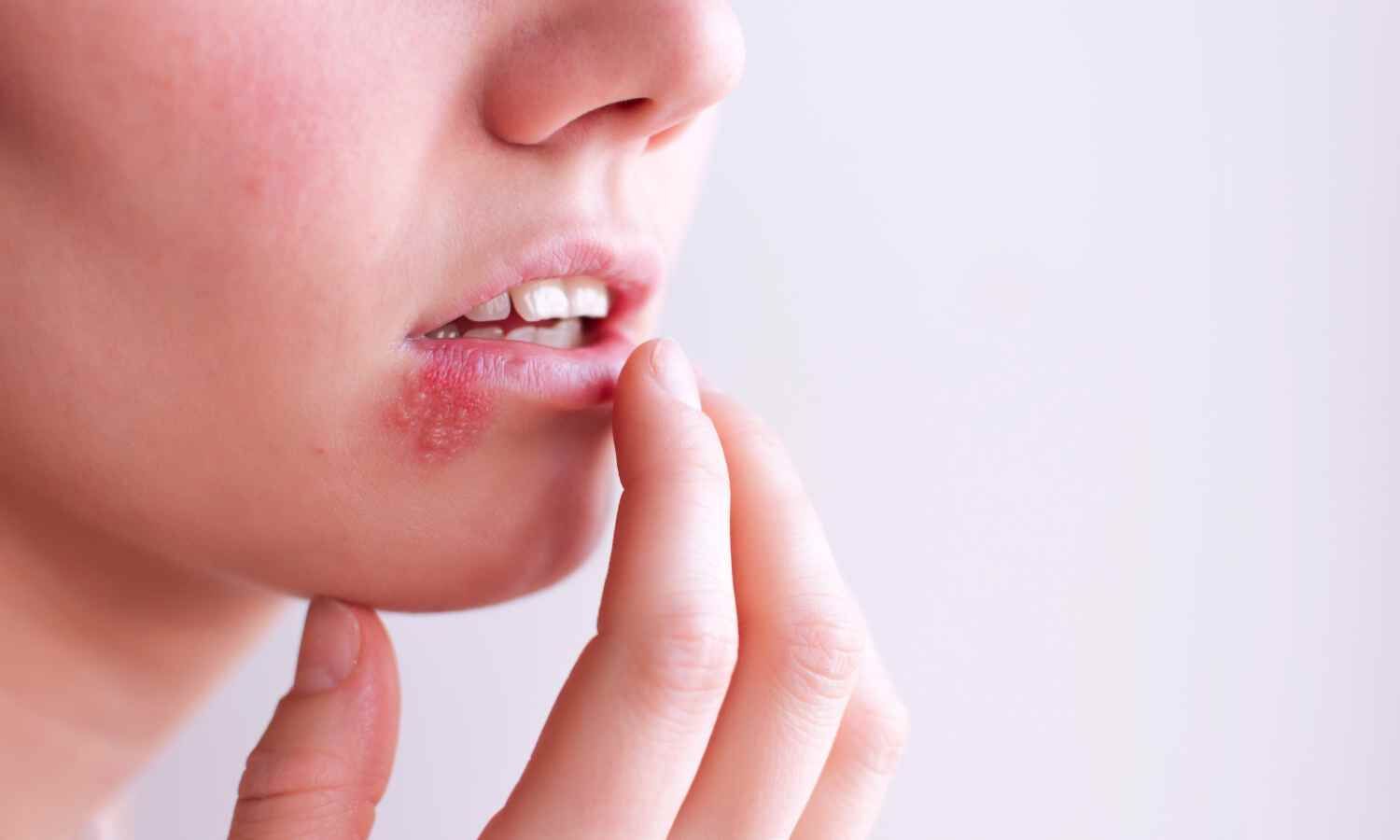 Pritelivir Shows Superior Efficacy for HSV in Immunocompromised Patients in phase 3 trial