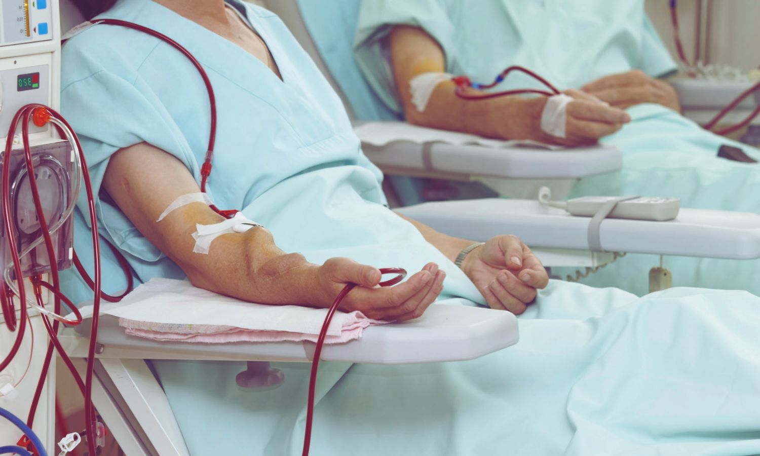Vascular Sound Index Shows Promise in Detecting Hemodialysis Access Stenosis: Study