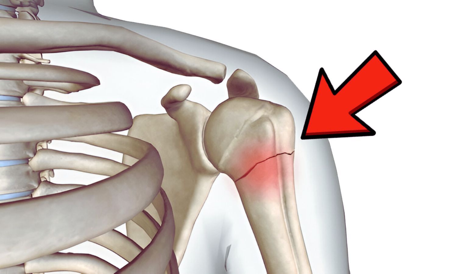 Study Finds Intramedullary Nailing Superior to Dual Plating in Selected Shoulder Fractures