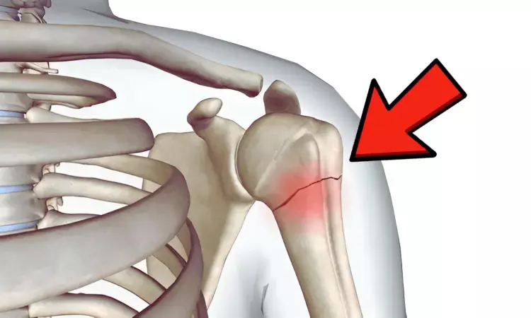 Study Finds Intramedullary Nailing Superior to Dual Plating in Selected Shoulder Fractures Study Finds Intramedullary Nailing Superior to Dual Plating in Selected Shoulder Fractures