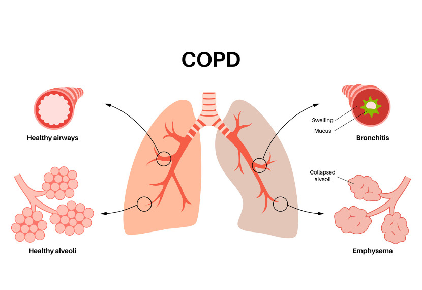 HALP Score Predicts 30-Day Readmission in acute exacerbation of COPD : Study