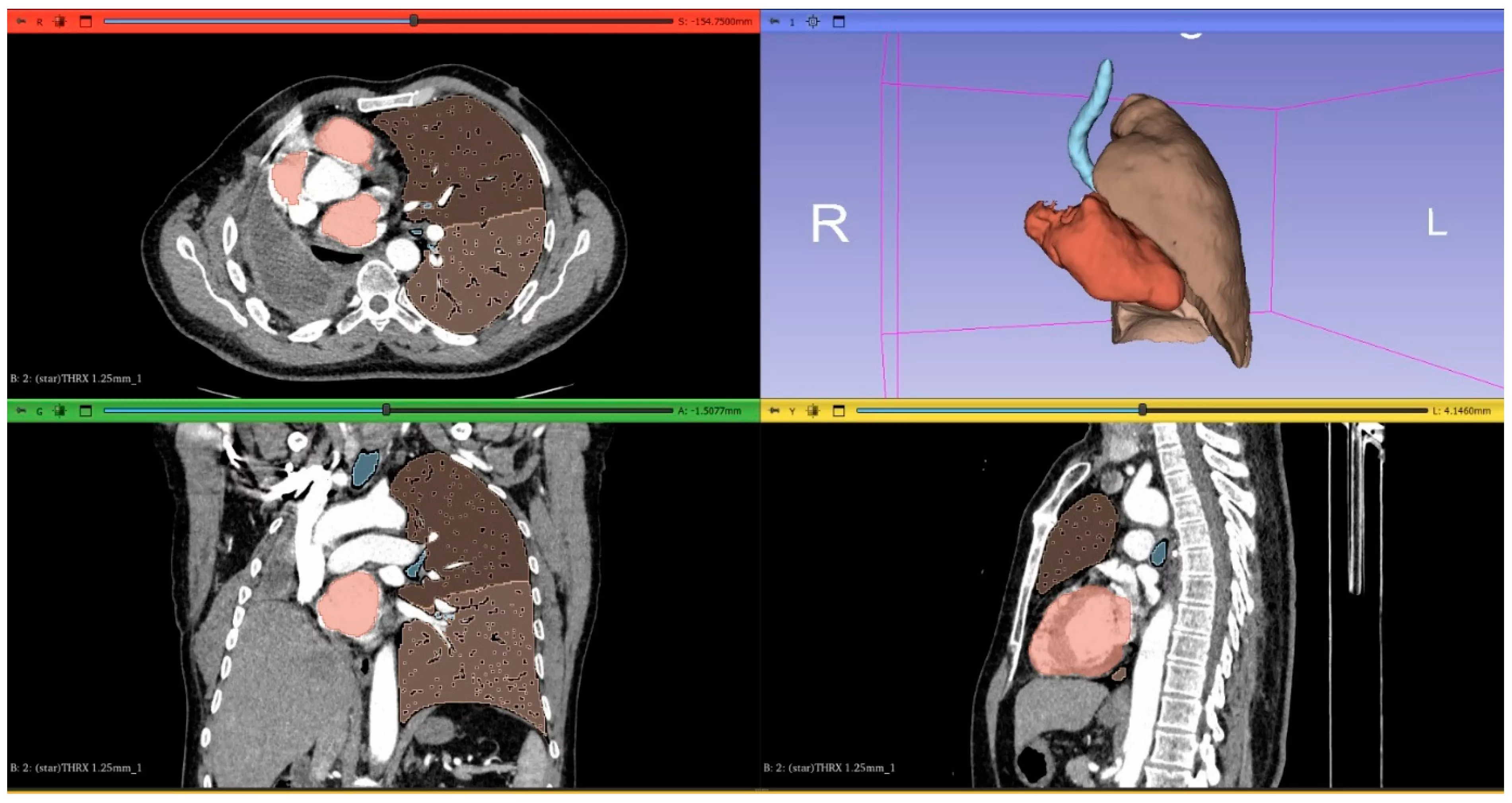 3D-CT Indices Enhance Postoperative Lung Remodeling Assessment, improve risk stratification: Study