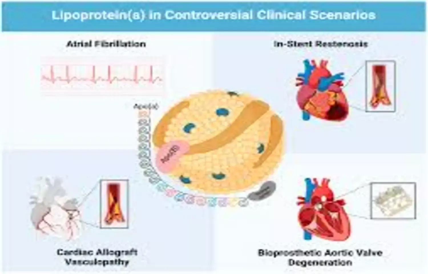 Elevated Lp(a) and Diabetes Synergistically Increase Mortality Risk in CAD, reports research