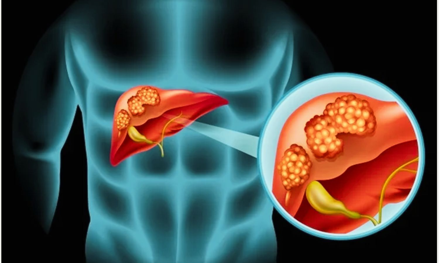 Neoadjuvant GOLP Boosts Event-Free Survival in High-Risk Intrahepatic Cholangiocarcinoma: NEJM Study