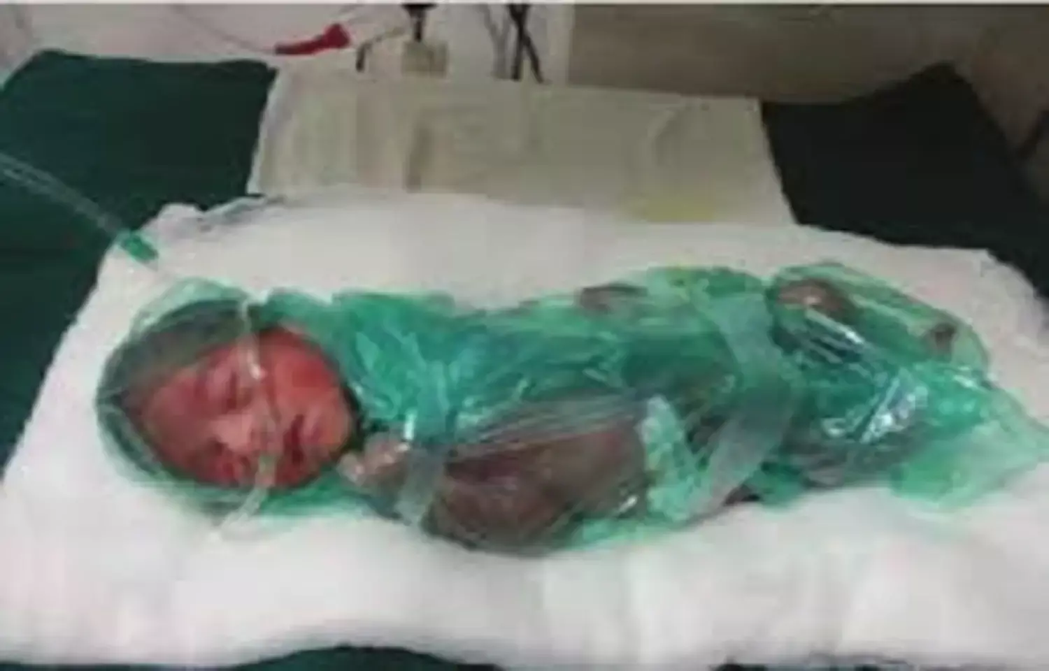 Drying Before Plastic Wrapping Does Not Improve Temperature Control in Very Preterm Infants: JAMA