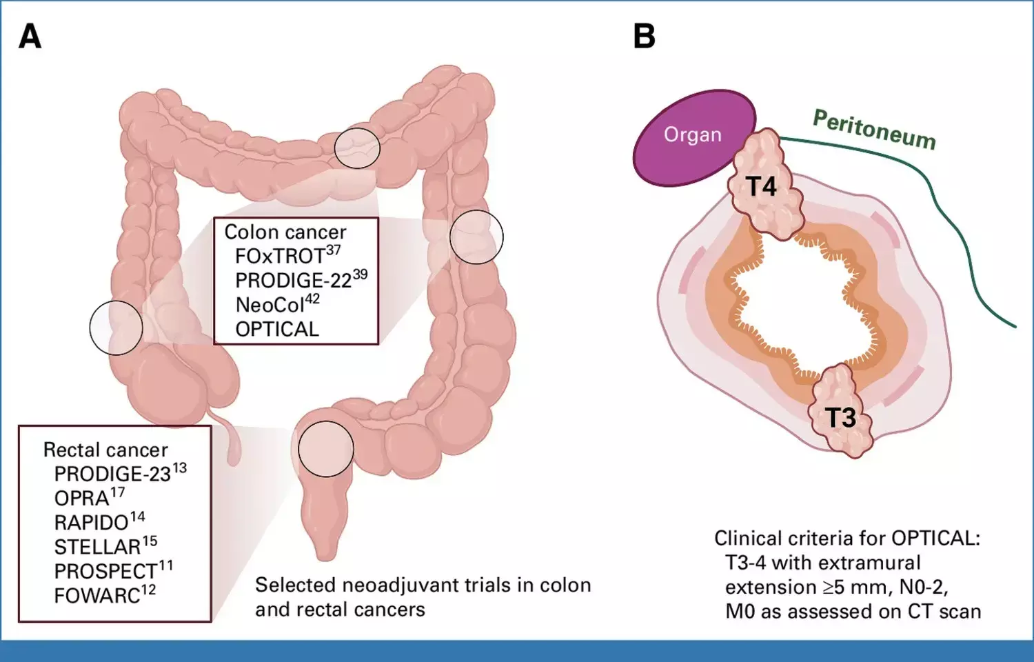 Neoadjuvant Chemotherapy Not Superior to Upfront Surgery in Colon Cancer: JAMA