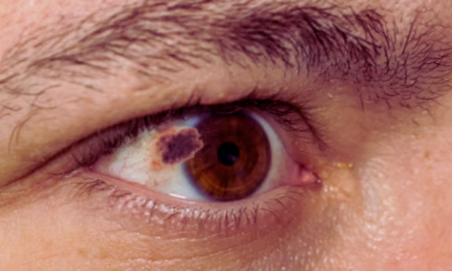 Dual Immunotherapy With Liver-Directed Therapy Improves Outcomes in Metastatic Uveal Melanoma: The Lancet