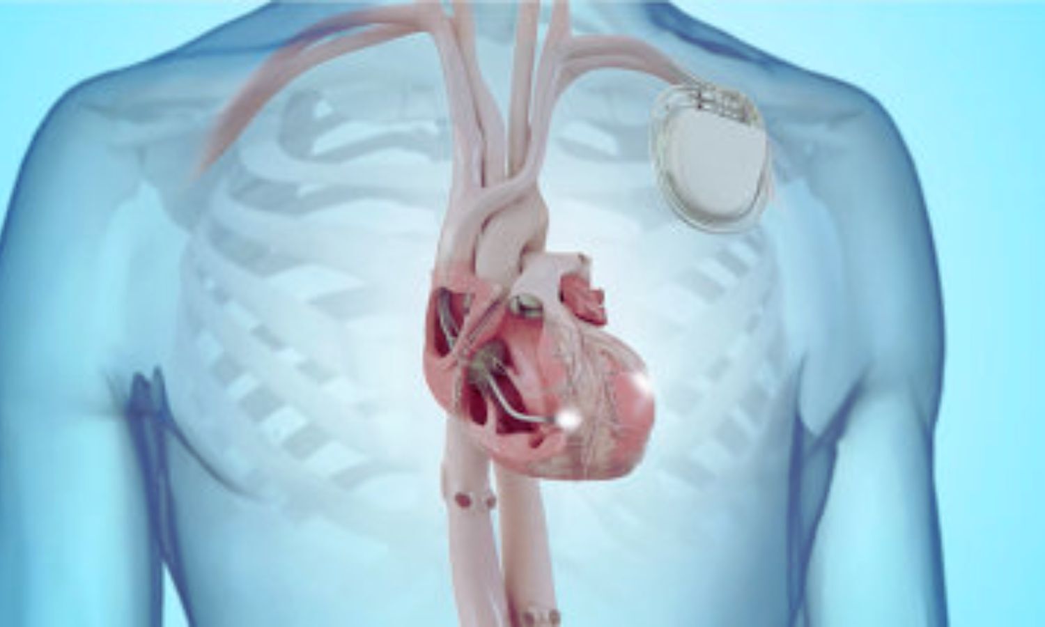 LBBP bests BiVP in Reducing Death or HF Hospitalization in LBBB with Severe LVEF Reduction: JAMA