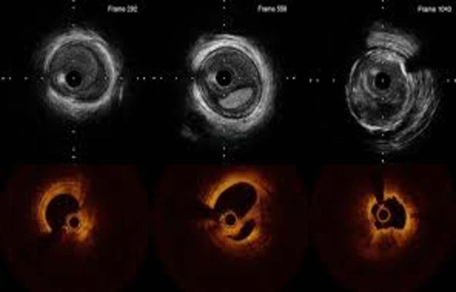 Intravascular Imaging may Improve Long-Term Outcomes in Complex PCI: Study