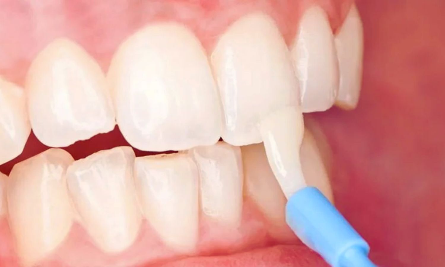 Fluoride Varnish Effective in Preventing Dental Caries: Study