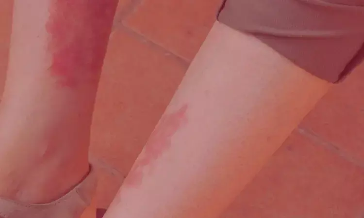 Hydralazine Linked to Slight Increase in Vasculitis Risk, But Overall Incidence Remains Low: Study Finds Hydralazine Linked to Slight Increase in Vasculitis Risk, But Overall Incidence Remains Low: Study Finds