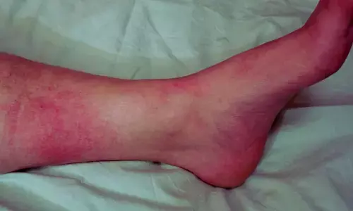 Linezolid Comparable to Clindamycin in Severe or Necrotizing SSTIs, Suggests Study