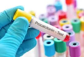 Procalcitonin-Guided Algorithm Reduces Mortality in Sepsis Without Delaying Antibiotics: Study
