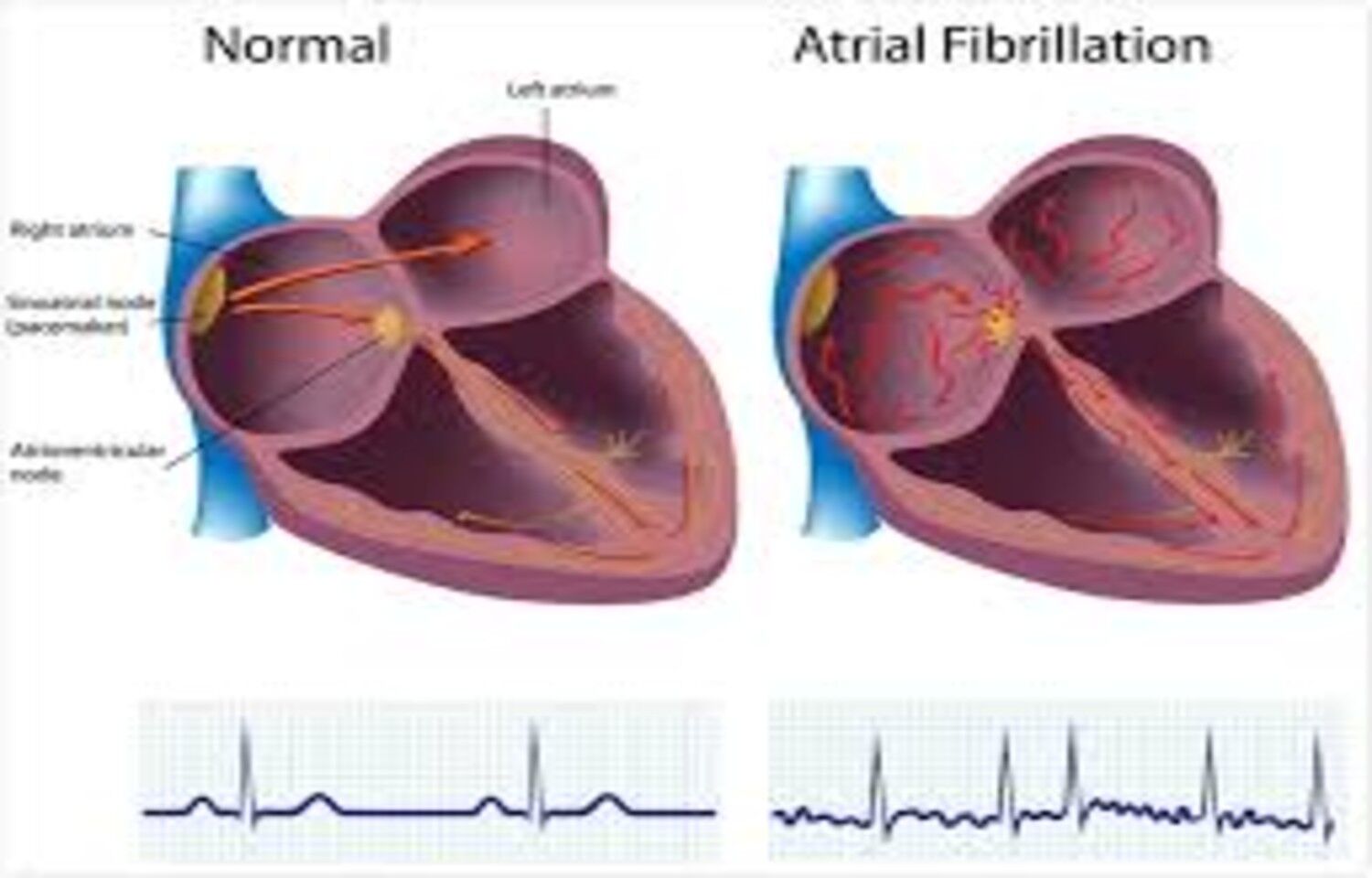 Memantine Reduces Atrial Arrhythmia Burden in Phase II Trial