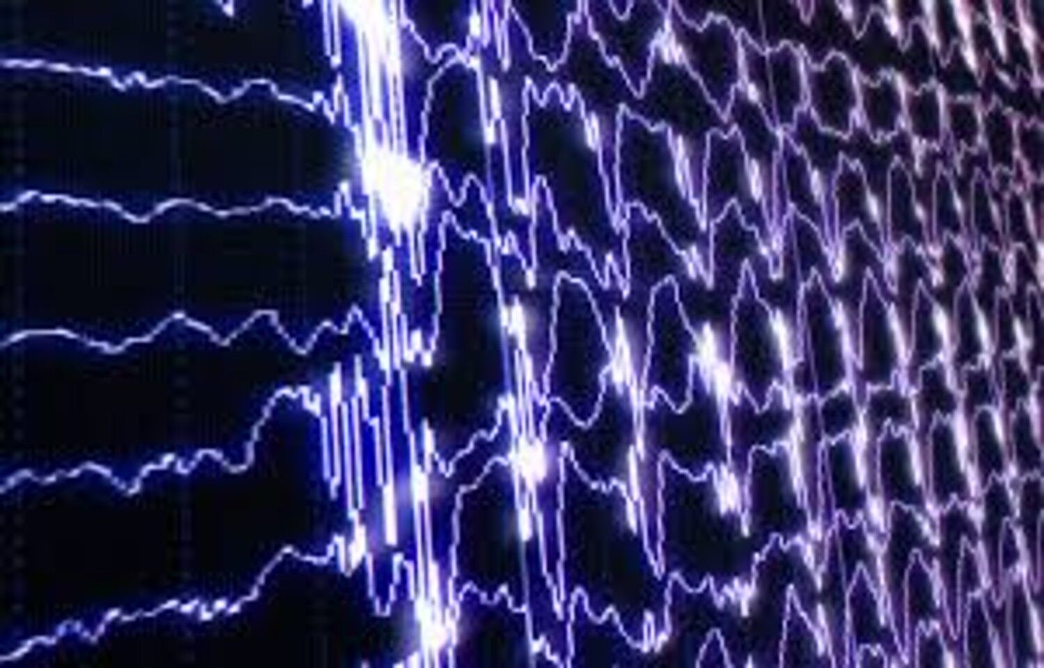 EEG-Based Brain Age Index promising Predictor of Dementia Risk: JAMA
