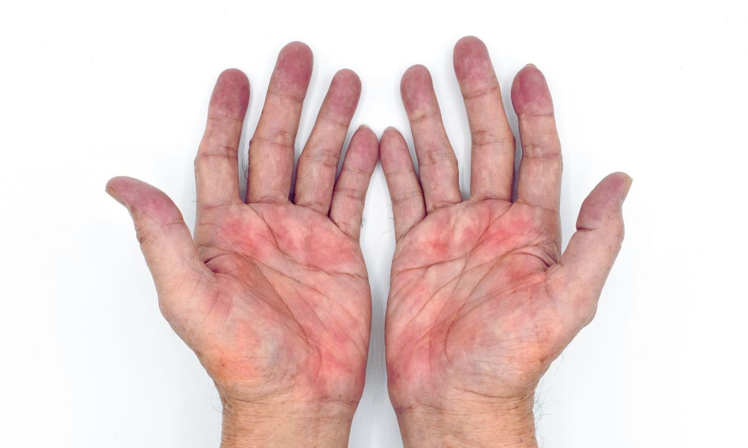 Fluconazole Successfully Treats Dupilumab-Associated Palmar Erythema: Case Report