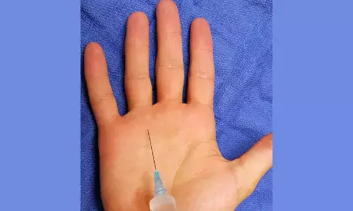 Steroid Injection for Stenosing Flexor Tenosynovitis linked to risk of Ganglion formation: Study Steroid Injection for Stenosing Flexor Tenosynovitis linked to risk of Ganglion formation: Study