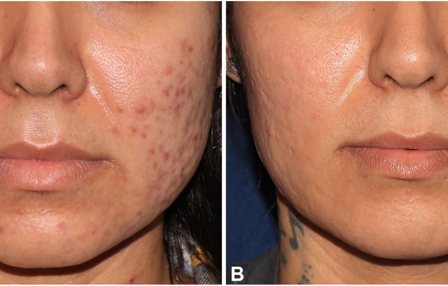 Red Light Therapy Reduces Acne Lesions with Enhanced Severity Improvement: Study