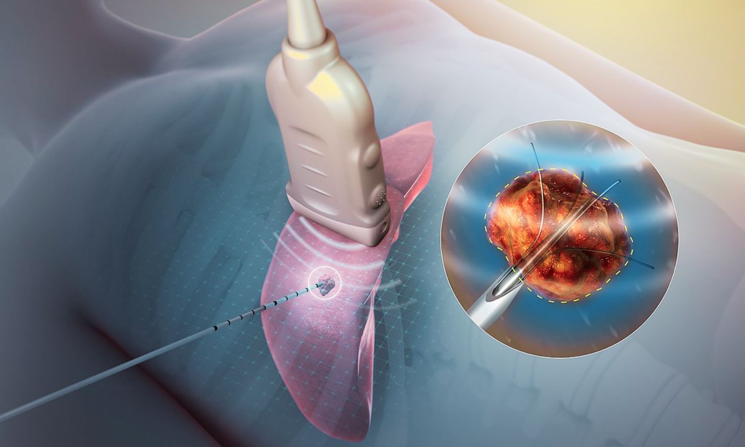 Radiofrequency Ablation Fails to Improve Survival and Worsens Quality of Life in Pancreatic Cancer: JAMA