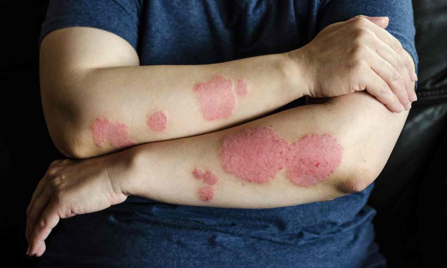 Zasocitinib Shows Strong Efficacy in Plaque Psoriasis in Phase 3 trials