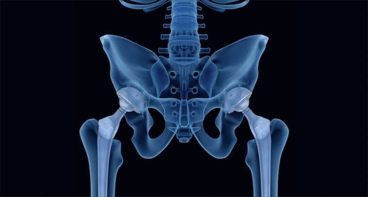 Extended Trochanteric Osteotomy may Raise Stem Subsidence Risk in Revision THA: Study
