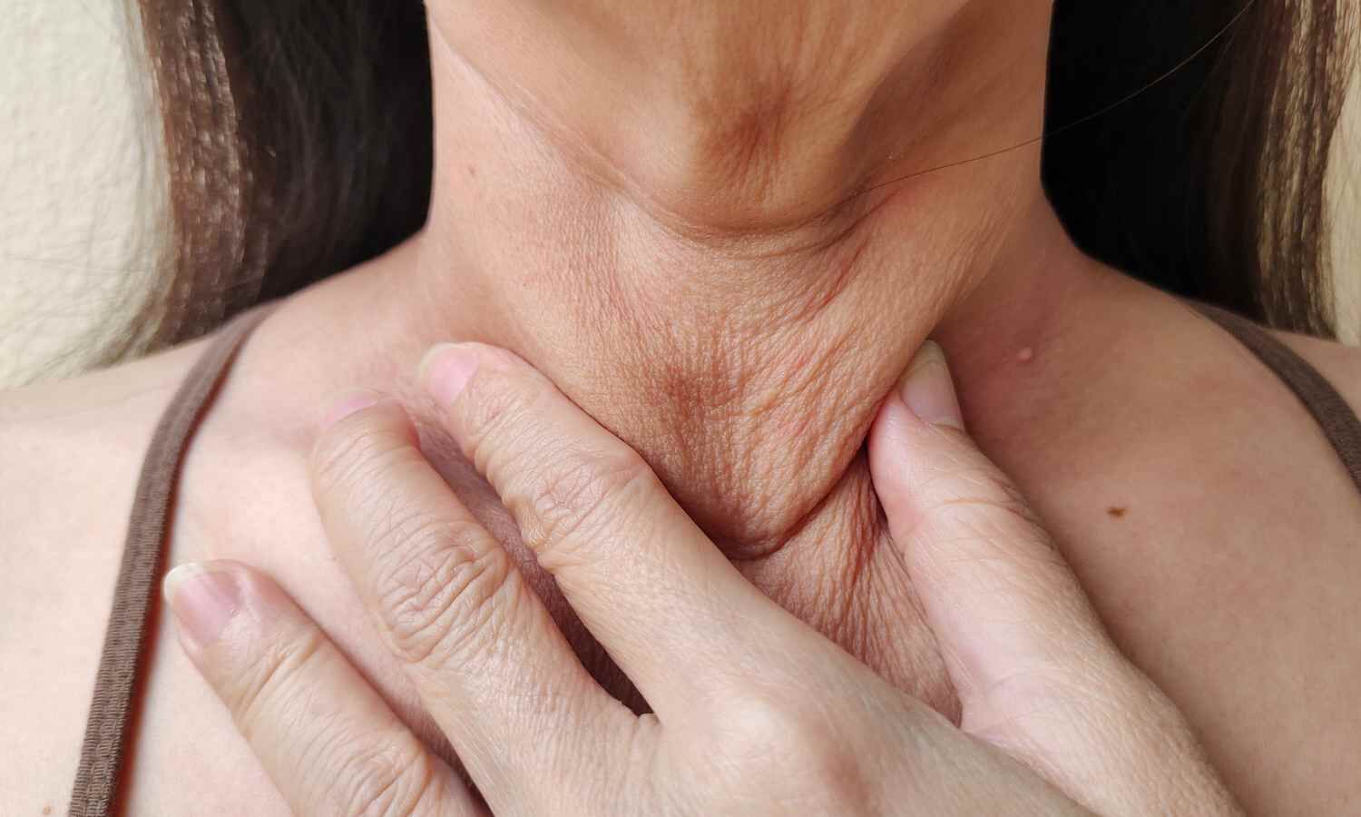 FDA Approves dermal filler Radiesse for Wrinkles in neck and chest area Despite Imaging Concerns