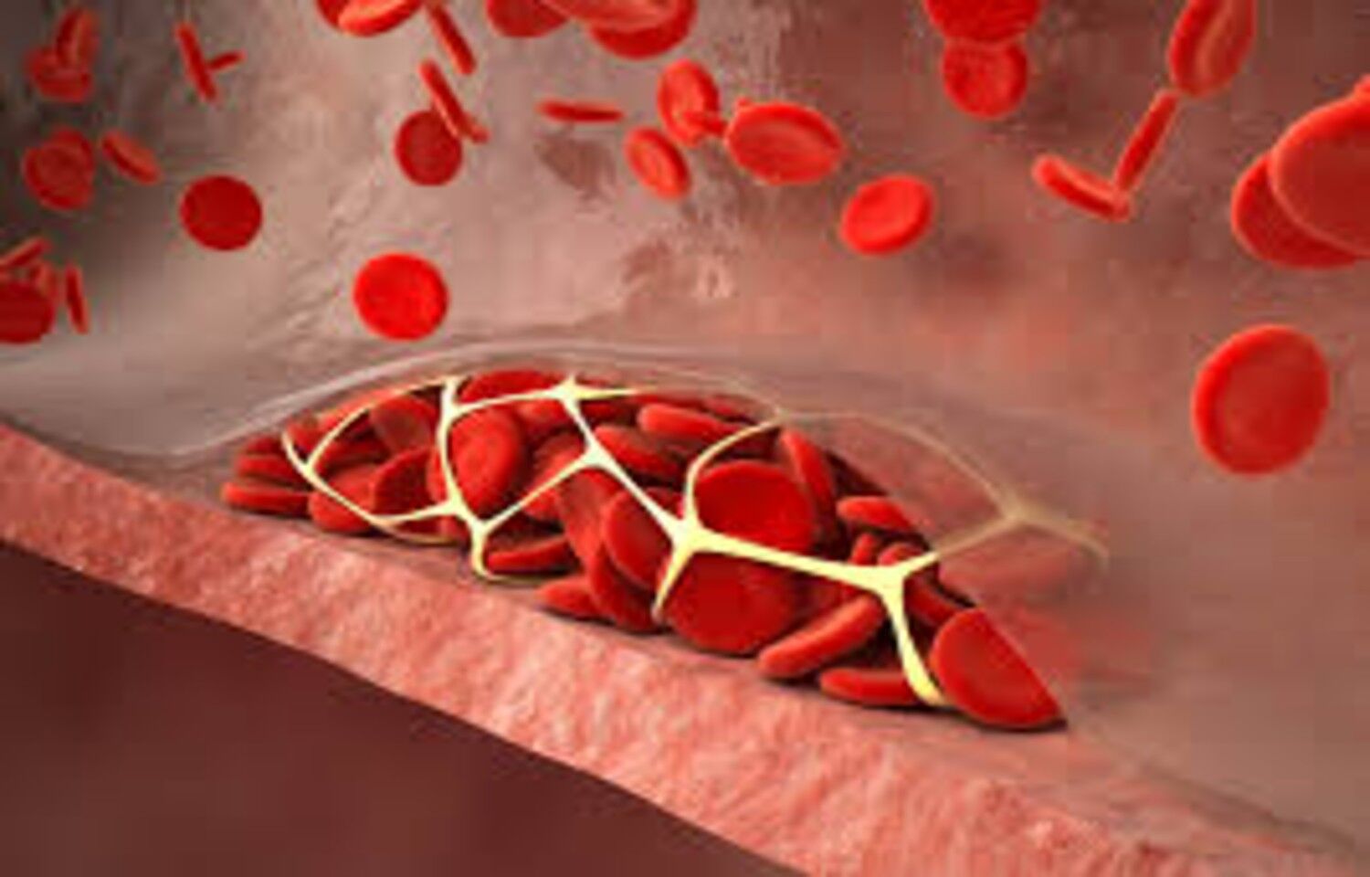 Children with IBD may face higher risk of VTE: Study