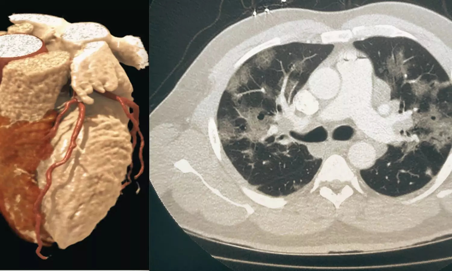 Vutrisiran Associated With Favorable Cardiac Remodeling in ATTR-CM: JAMA