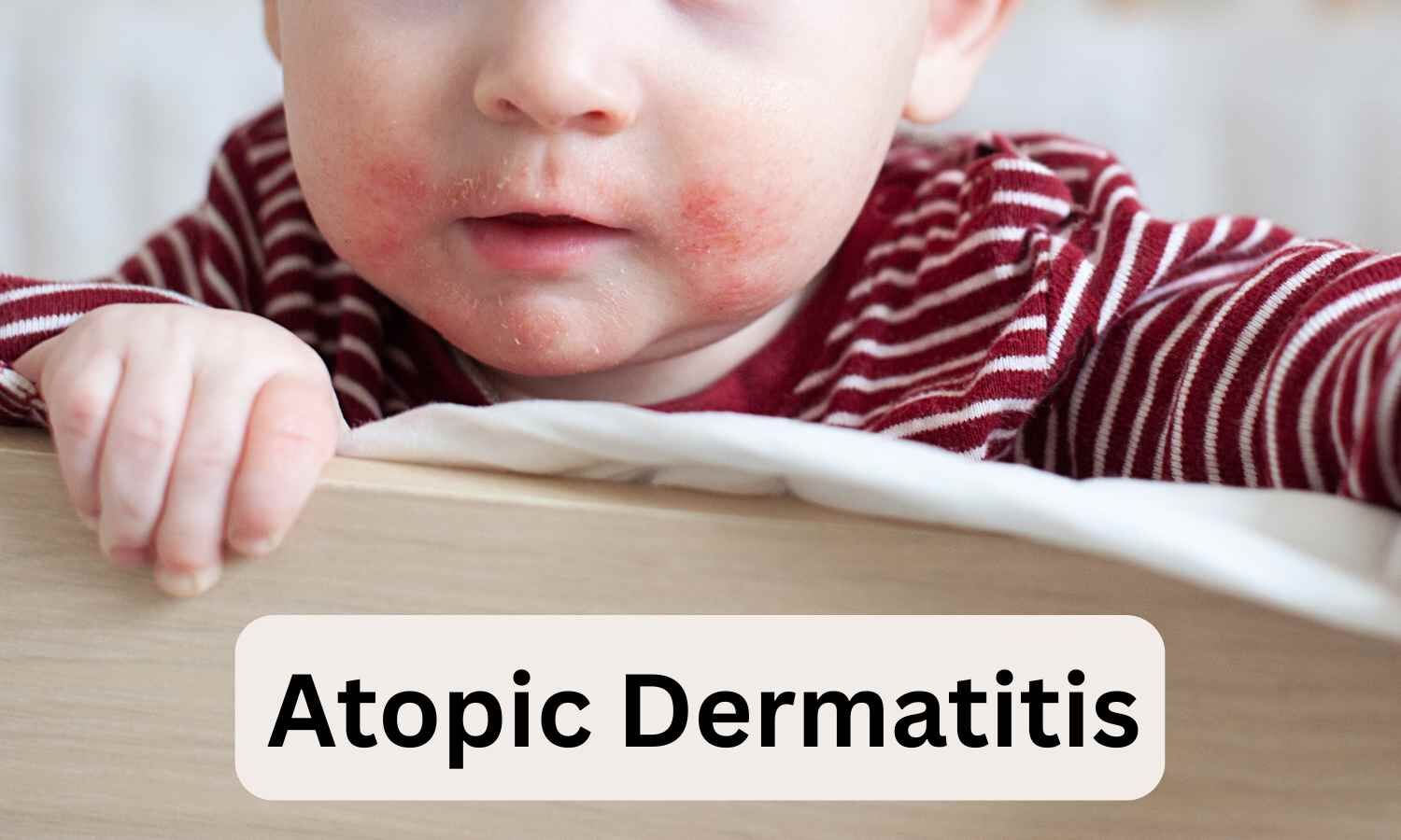 American Academy of Dermatology Issues First Pediatric Atopic Dermatitis Guidelines Highlighting Prevention and Expanded Therapies