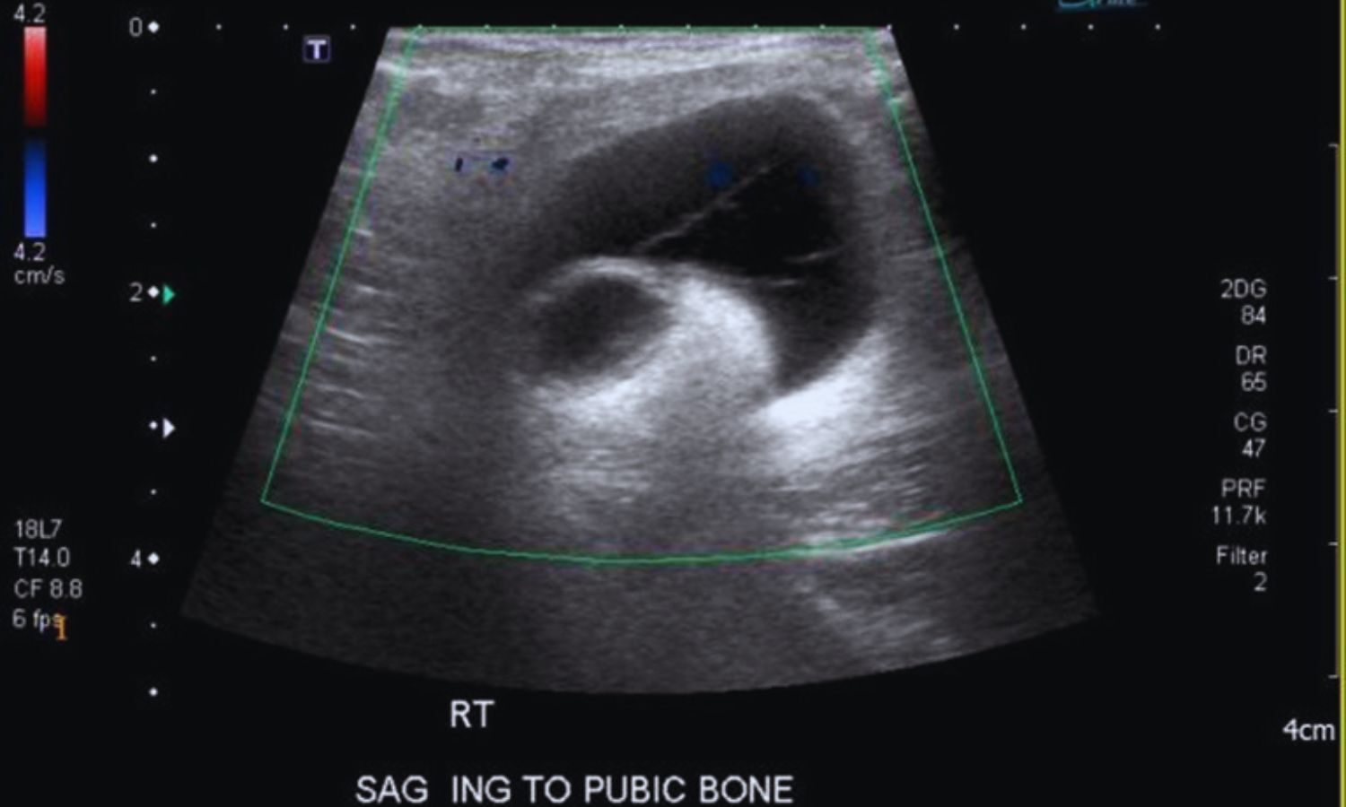 Meshoma: Rare Late Complication of Inguinal Hernia Detectable by Ultrasound — A Case Report