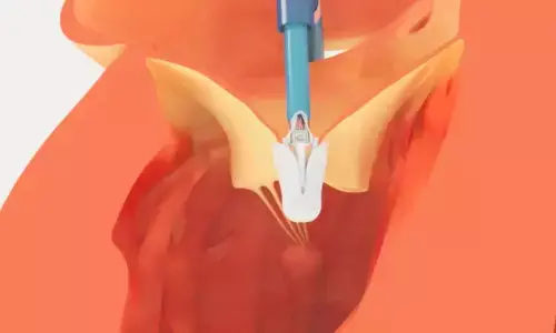 TTVR Tied to Safe and Effective Real-World Outcomes in Severe TR, Finds Study