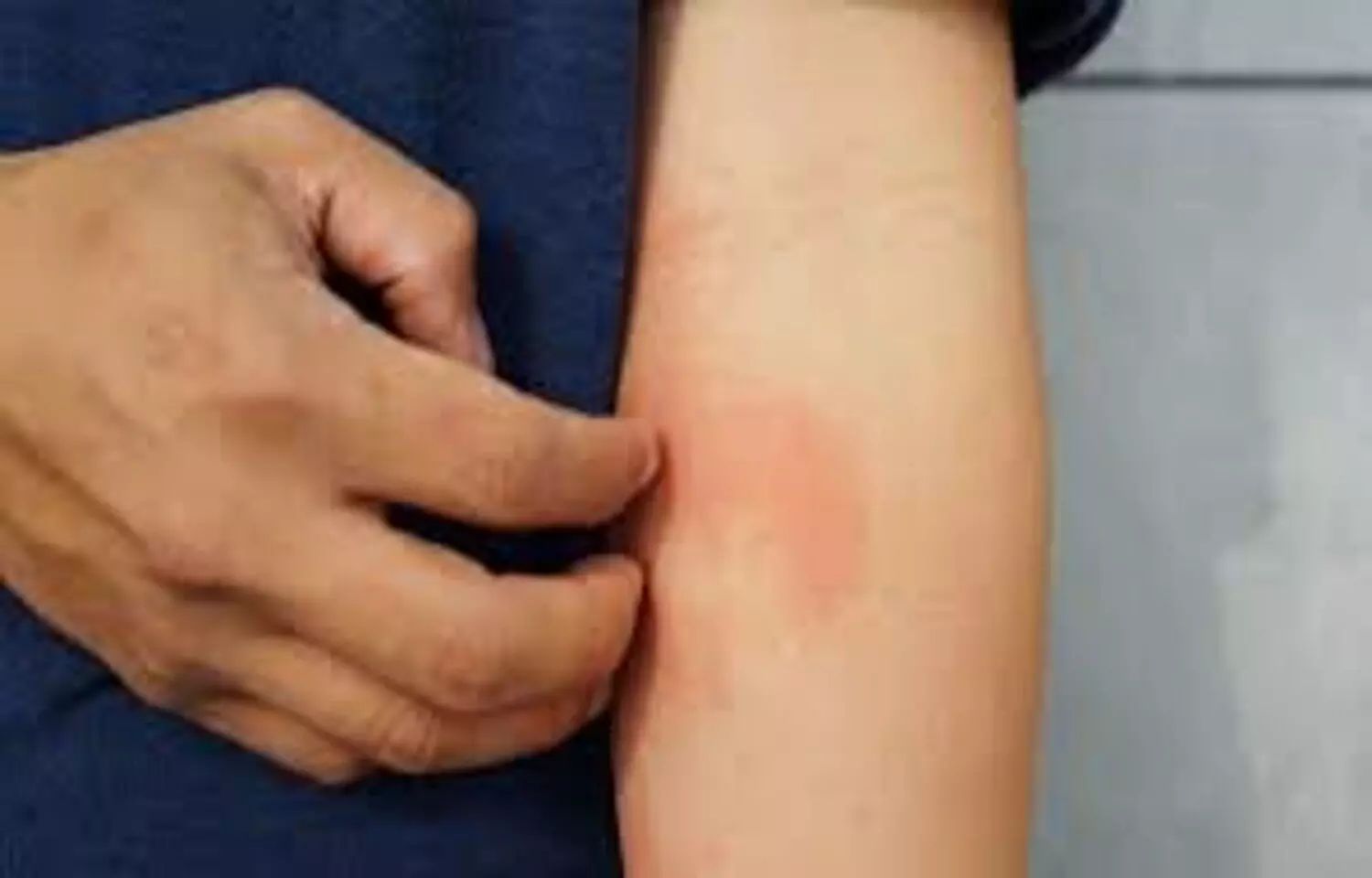 Atopic Dermatitis Linked to Increased Risk of Osteoporosis and Fractures