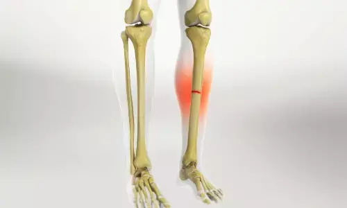 Adding Tobramycin to Vancomycin Fails to Reduce Infection Risk in Tibial Fracture Surgery: TOBRA Trial