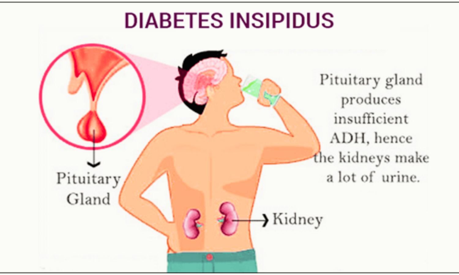 Lithium-Induced Nephrogenic Diabetes Insipidus Reversed with Timely Intervention: Case Report