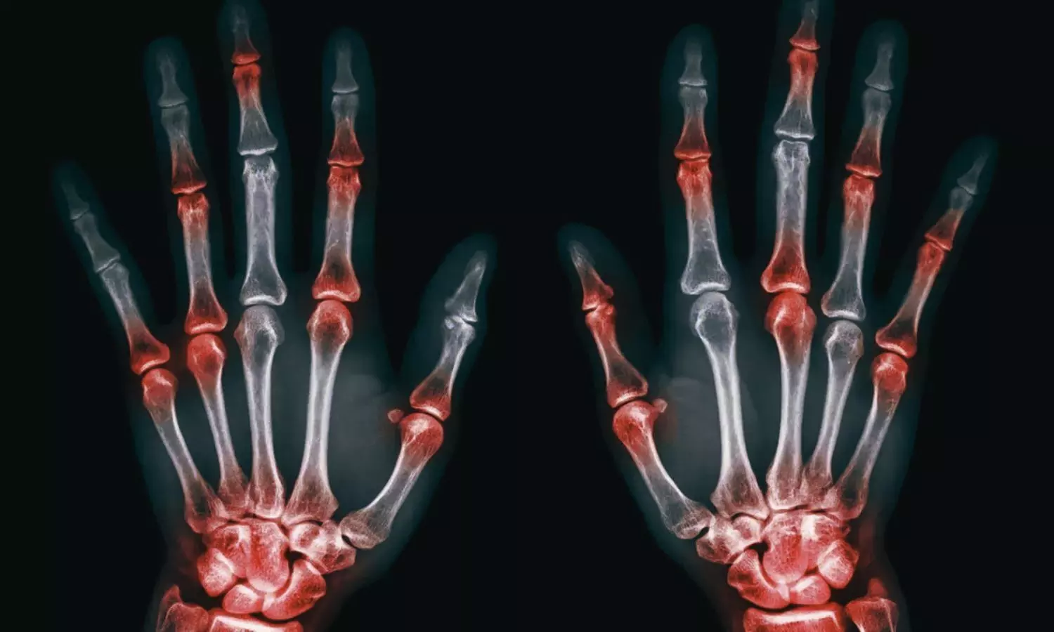 Advanced Imaging Enables Earlier Detection of Joint Inflammation in kids, finds research Advanced Imaging Enables Earlier Detection of Joint Inflammation in kids, finds research