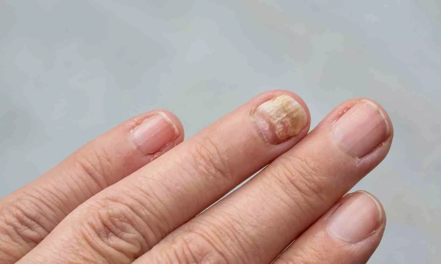 New study hints at the cause of a painful skin condition-and at a long-awaited potential treatment