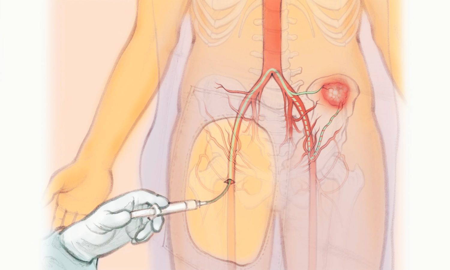 Renal Allograft Embolization Safer Alternative for Failed Kidney Allografts with Key Precautions, Reveals Research