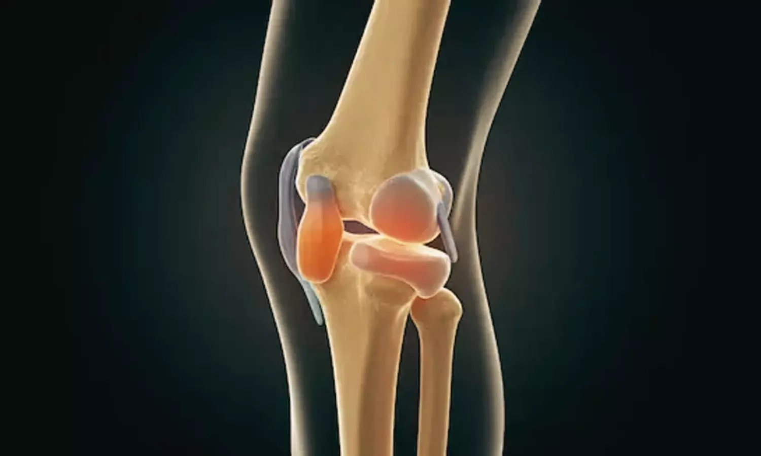 Natural GLP-1 in Joint Fluid Shows Potential for Treating Arthritis: The Lancet