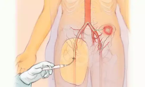 Renal Allograft Embolization Safer Alternative for Failed Kidney Allografts with Key Precautions, Reveals Research