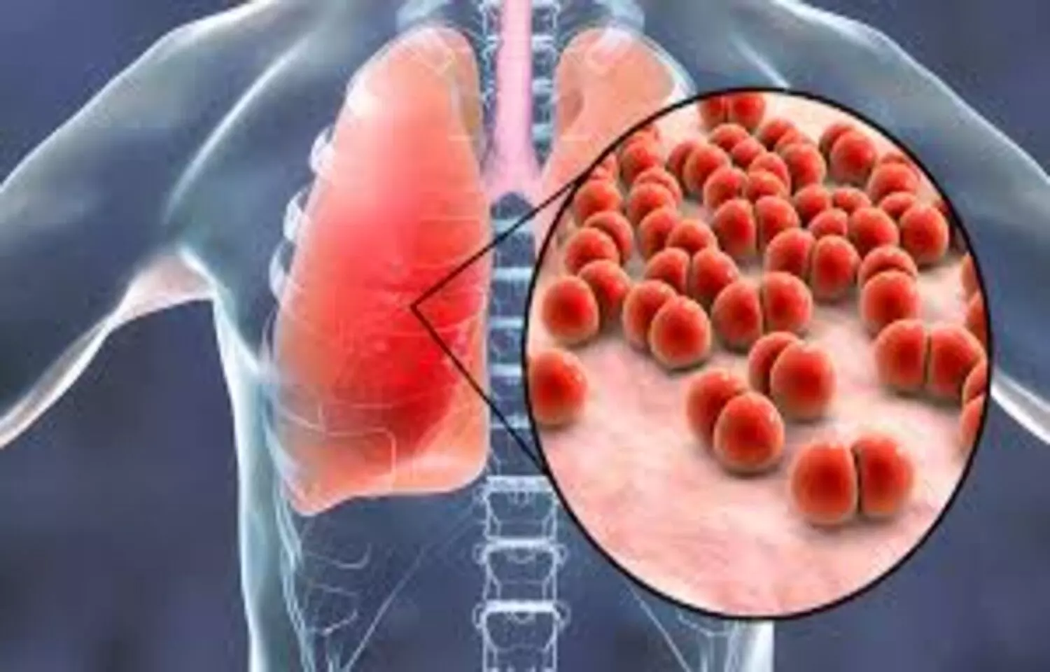 Low Eosinophil Counts Predict Higher Resource Use in Community-Acquired Pneumonia: Study